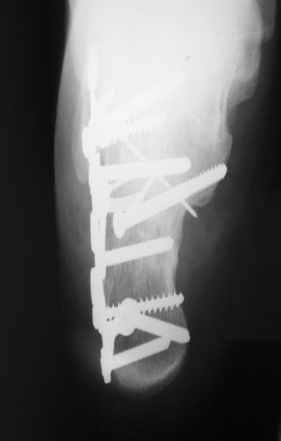 Locking Calcaneal Plate (Implant 279)